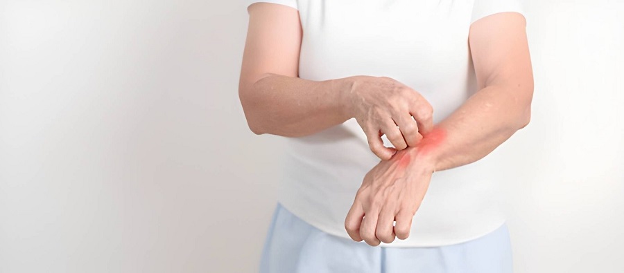 Best Psoriasis Treatment in Andheri
